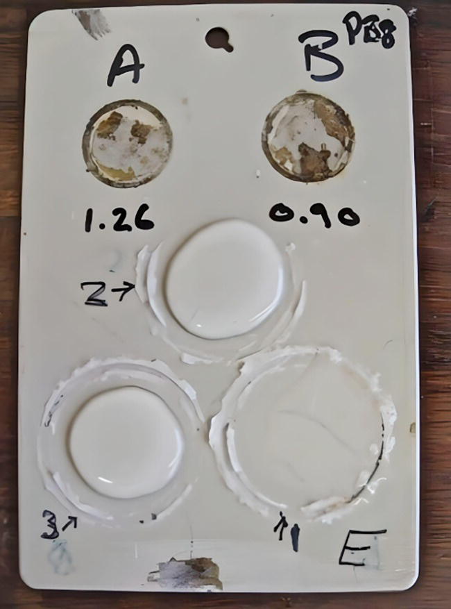 A photograph of a serological testing slide with multiple circular wells, likely used for blood typing or antibody screening. Some wells show visible agglutination, indicating a reaction with specific antibodies, while others do not.