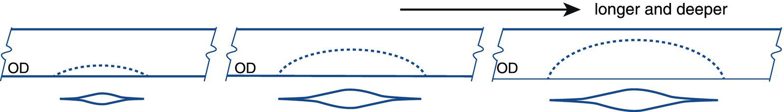 An illustration of the effect of crack length and depth on crack mouth opening displacement and undercut formation, highlighting variations in crack geometry and deformation behavior.